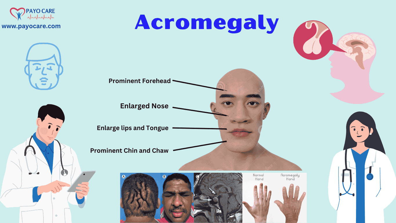 Acromegaly: Types, Causes, Symptoms & Treatment
