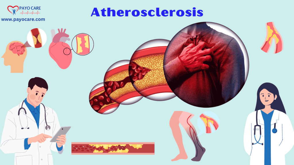 Atherosclerosis :Types, Causes, Symptoms, Prevention, Diagnosis & Treatment Atherosclerosis :Types, Causes, Symptoms, Prevention, Diagnosis & Treatment
