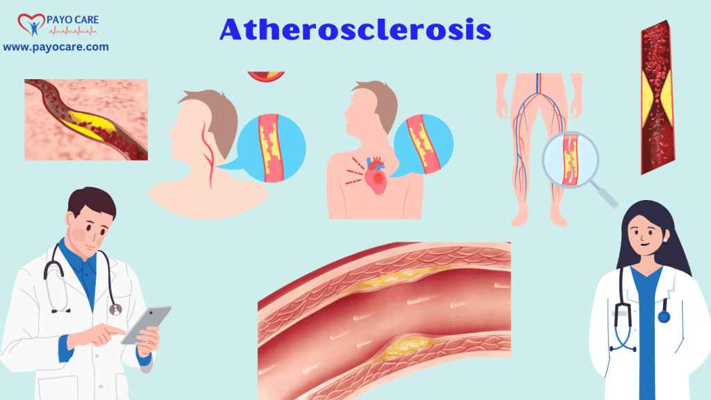 Atherosclerosis :Types, Causes, Symptoms, Prevention, Diagnosis & Treatment Atherosclerosis :Types, Causes, Symptoms, Prevention, Diagnosis & Treatment