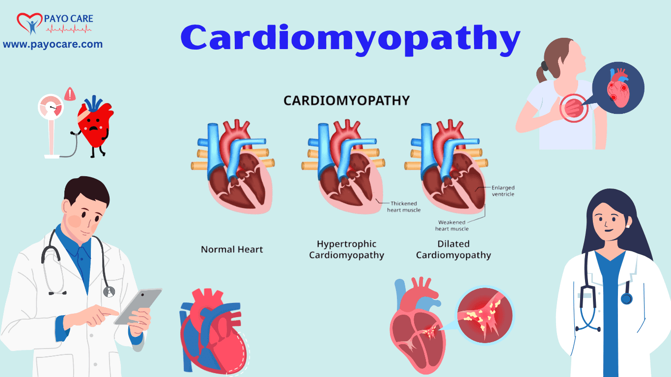 Cardiomyopathy :Causes, Symptoms, Prevention & Treatment