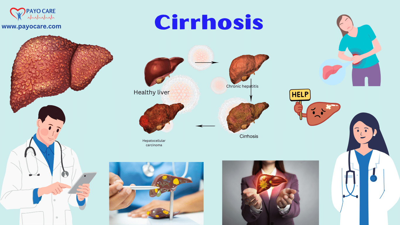 Cirrhosis: Types, Causes, Symptoms & Treatment