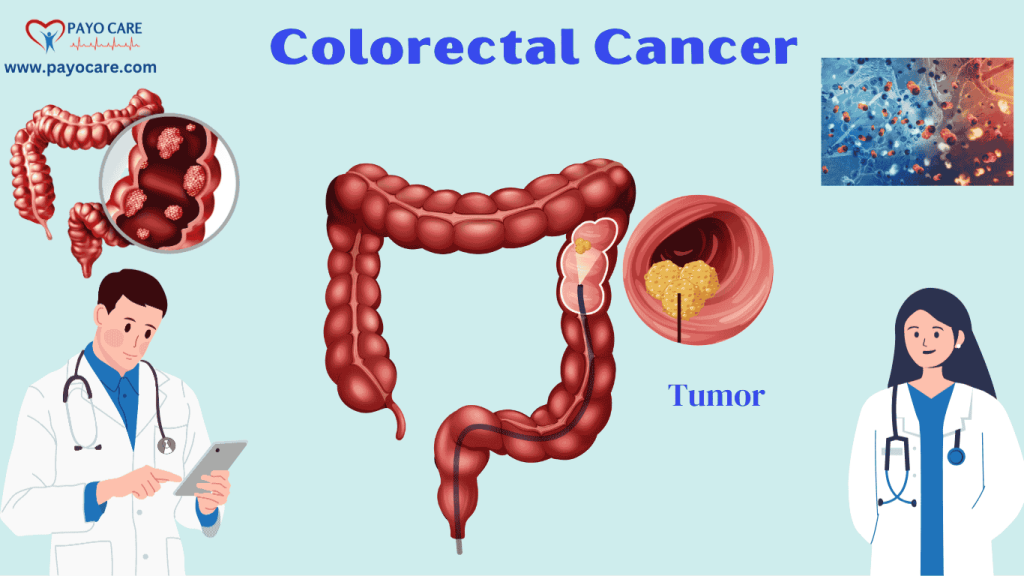 Colorectal Cancer: Causes, Symptoms & Treatments Colorectal Cancer: Causes, Symptoms & Treatments