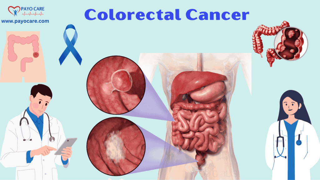 Colorectal Cancer: Causes, Symptoms & Preventions Colorectal Cancer: Causes, Symptoms & Preventions