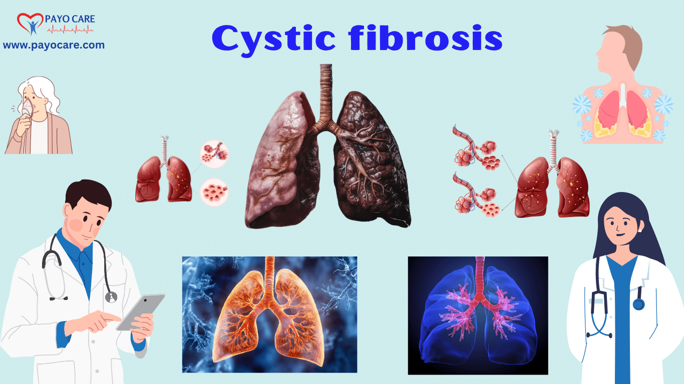 Cystic Fibrosis: Causes, Symptoms, Prevention & Treatment
