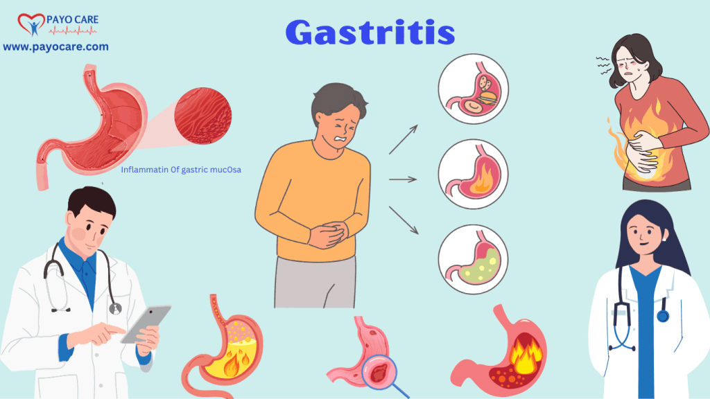 Gastritis: Types, Causes, Symptoms, Prevention,