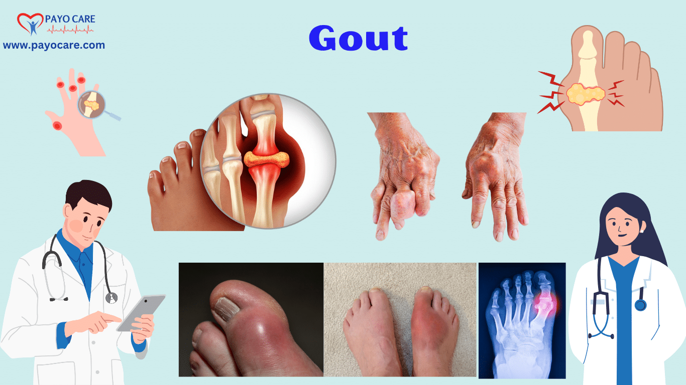 Gout: Causes, Symptoms, Prevention & Treatment