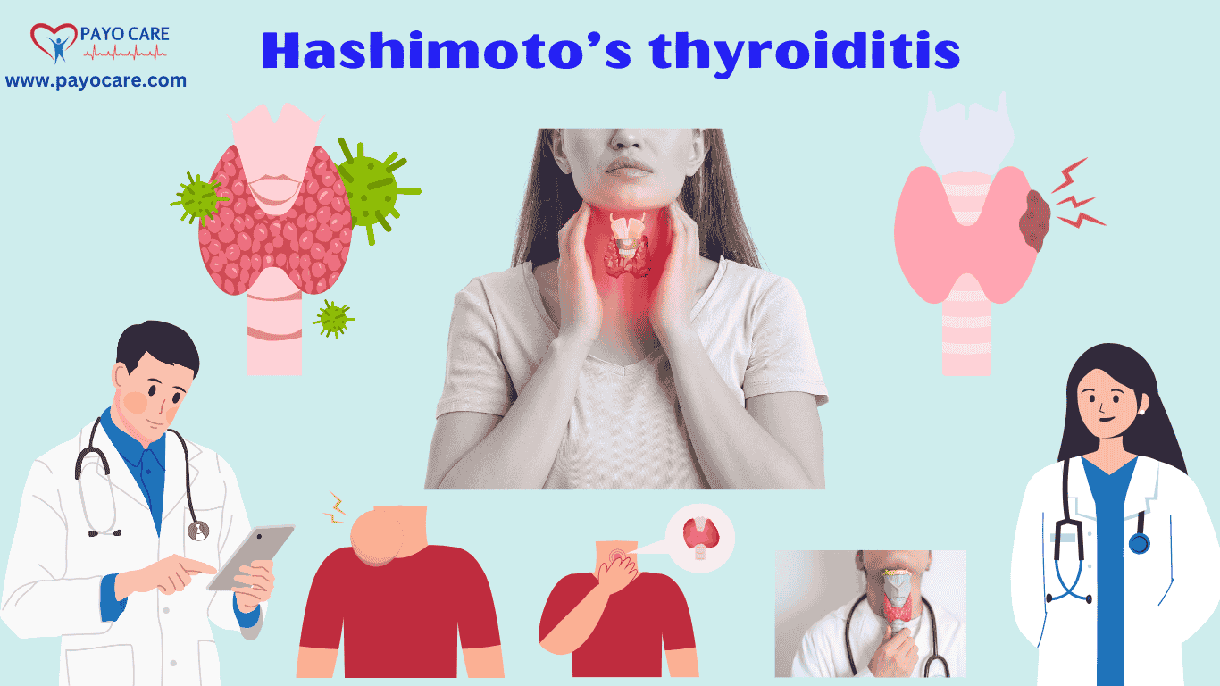 Hashimoto’s thyroiditis :Causes, Symptoms & Treatment