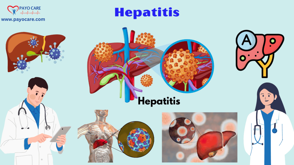 Hepatitis: Types, Causes, Symptoms, Prevention, Diagnosis & Treatment Hepatitis: Types, Causes, Symptoms, Prevention, Diagnosis & Treatment
