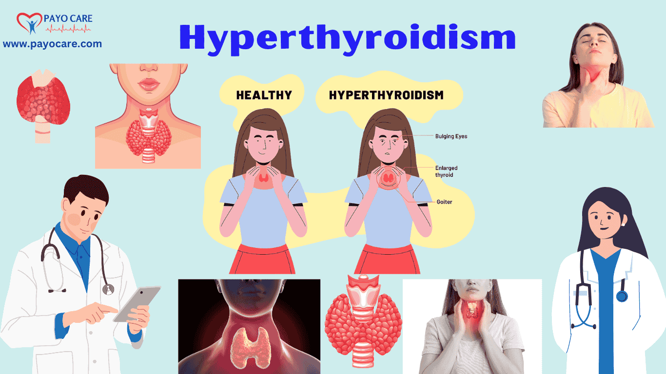 Hyperthyroidism: Types, Causes, Symptoms & Treatment