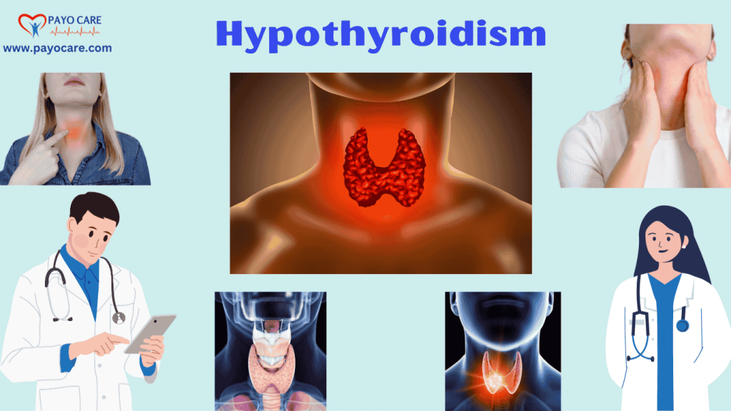 Hypothyroidism: Causes, Symptoms, & Treatment Hypothyroidism: Causes, Symptoms, & Treatment
