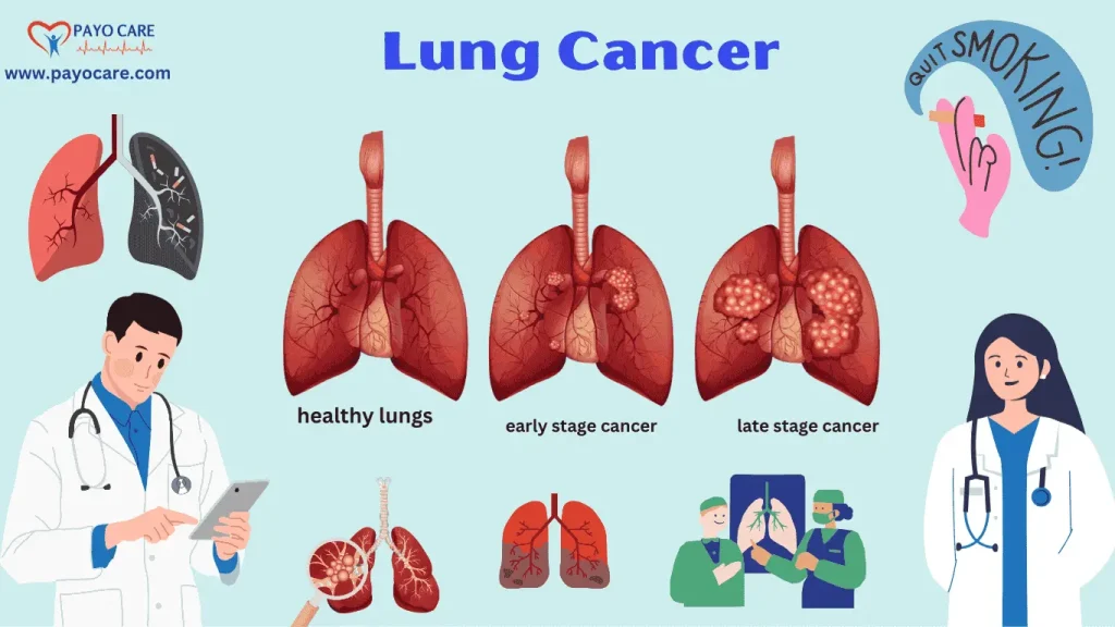 Lung Cancer:types,causes,symptoms,treatment,prevention and diagnosis Lung Cancer:types,causes,symptoms,treatment,prevention and diagnosis