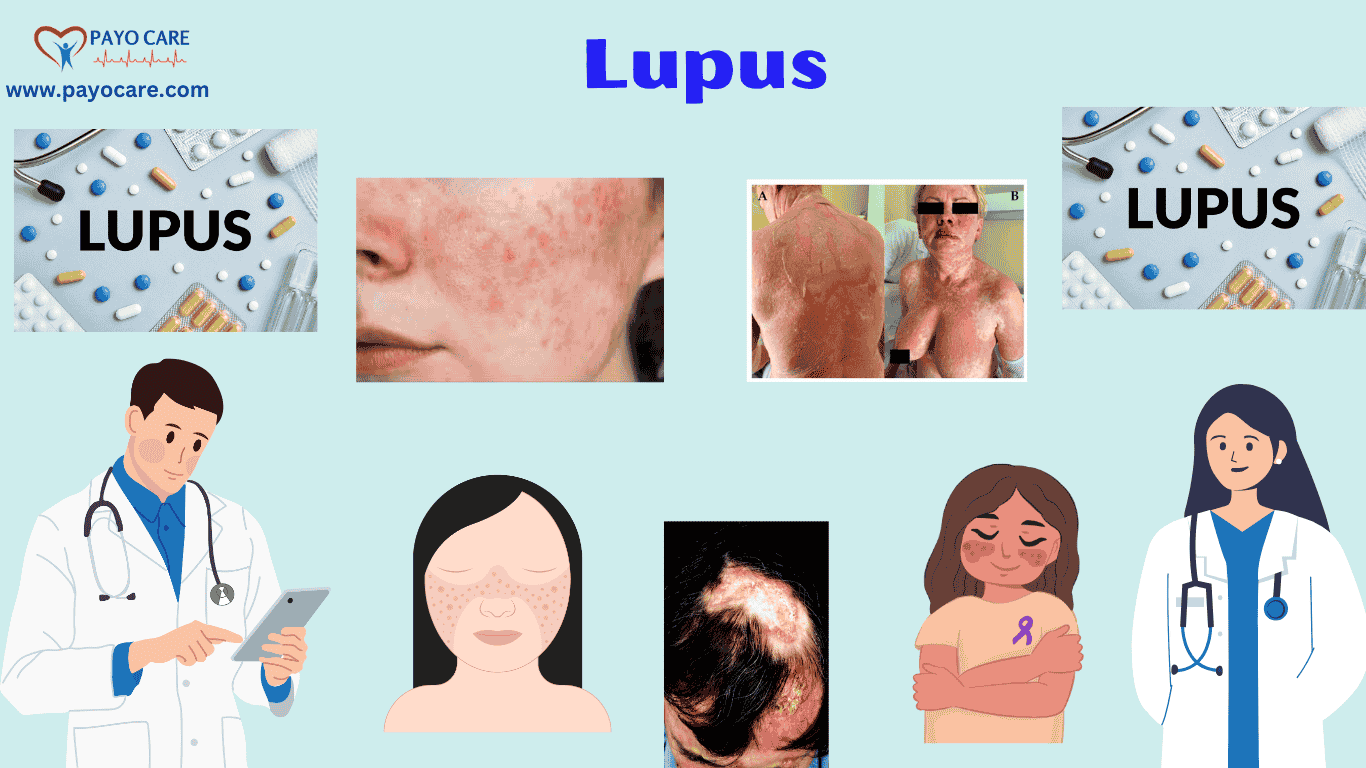 Lupus :Causes, Symptoms, Prevention & Treatment