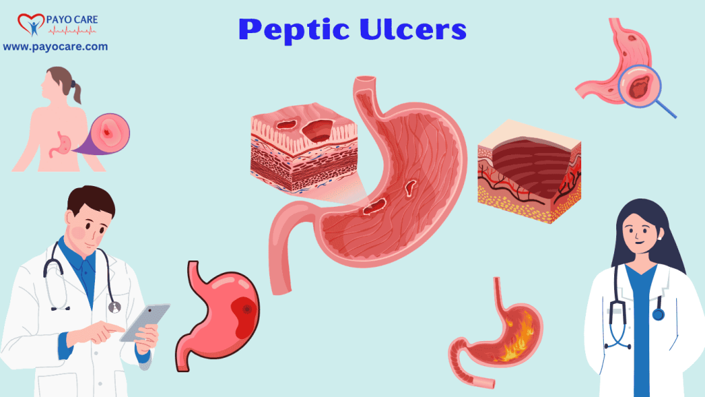 Peptic Ulcers: Types, Causes, Symptoms, Prevention, Diagnosis & Treatment Peptic Ulcers: Types, Causes, Symptoms, Prevention, Diagnosis & Treatment