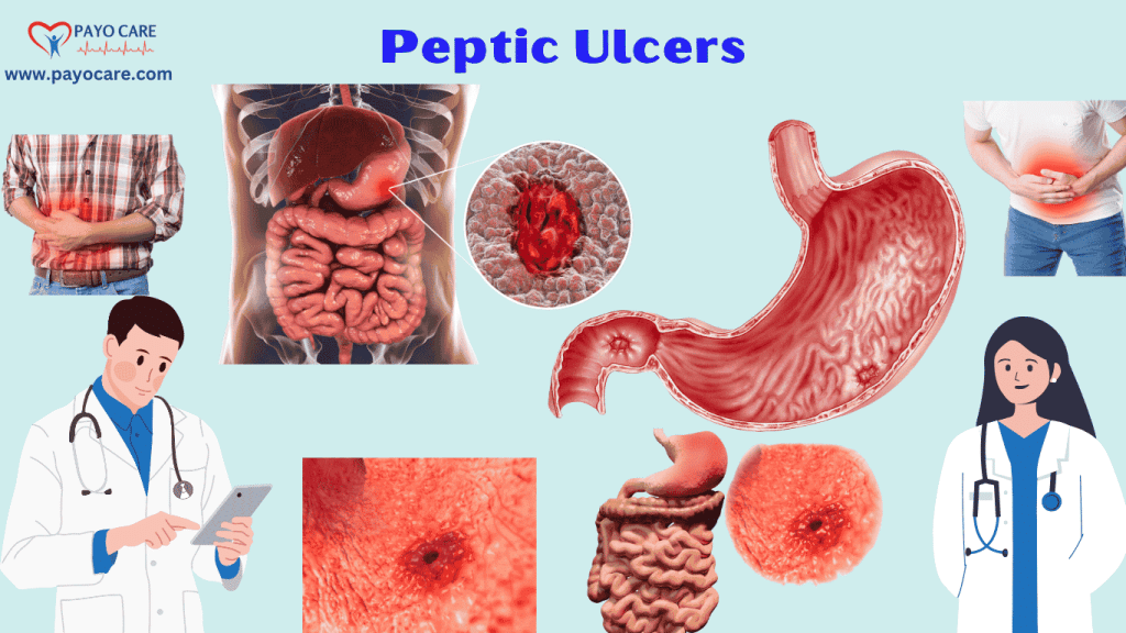 Peptic Ulcers: Types, Causes, Symptoms, Prevention, Diagnosis & Treatment Peptic Ulcers: Types, Causes, Symptoms, Prevention, Diagnosis & Treatment