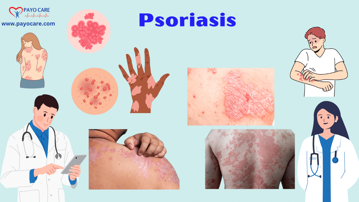 Psoriasis:Causes, Symptoms & Treatment