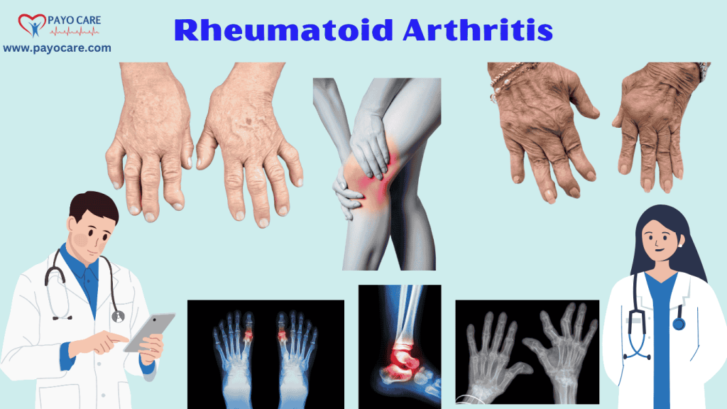 Rheumatoid Arthritis :Types, Causes, Symptoms, Prevention, Diagnosis & Treatment Rheumatoid Arthritis :Types, Causes, Symptoms, Prevention, Diagnosis & Treatment
