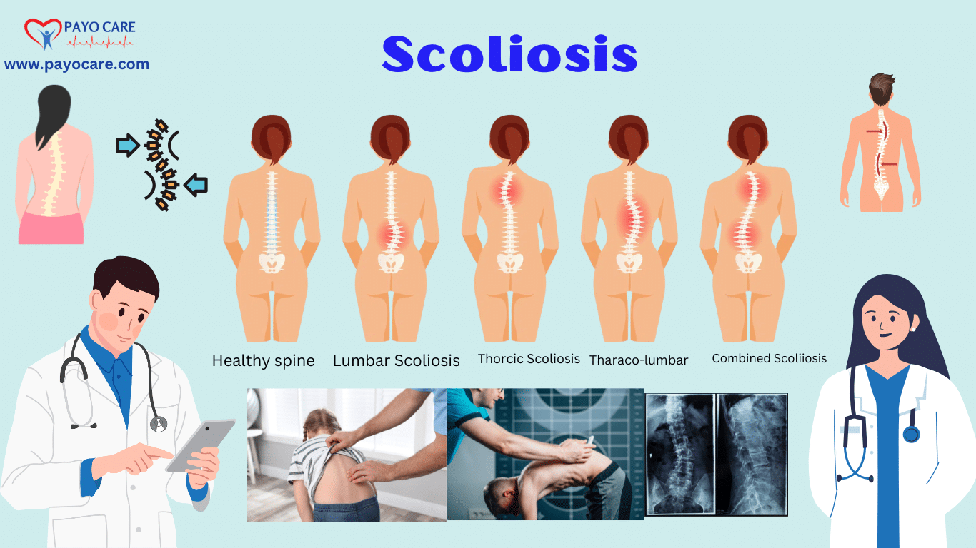 Scoliosis:Causes, Symptoms, Prevention & Treatment