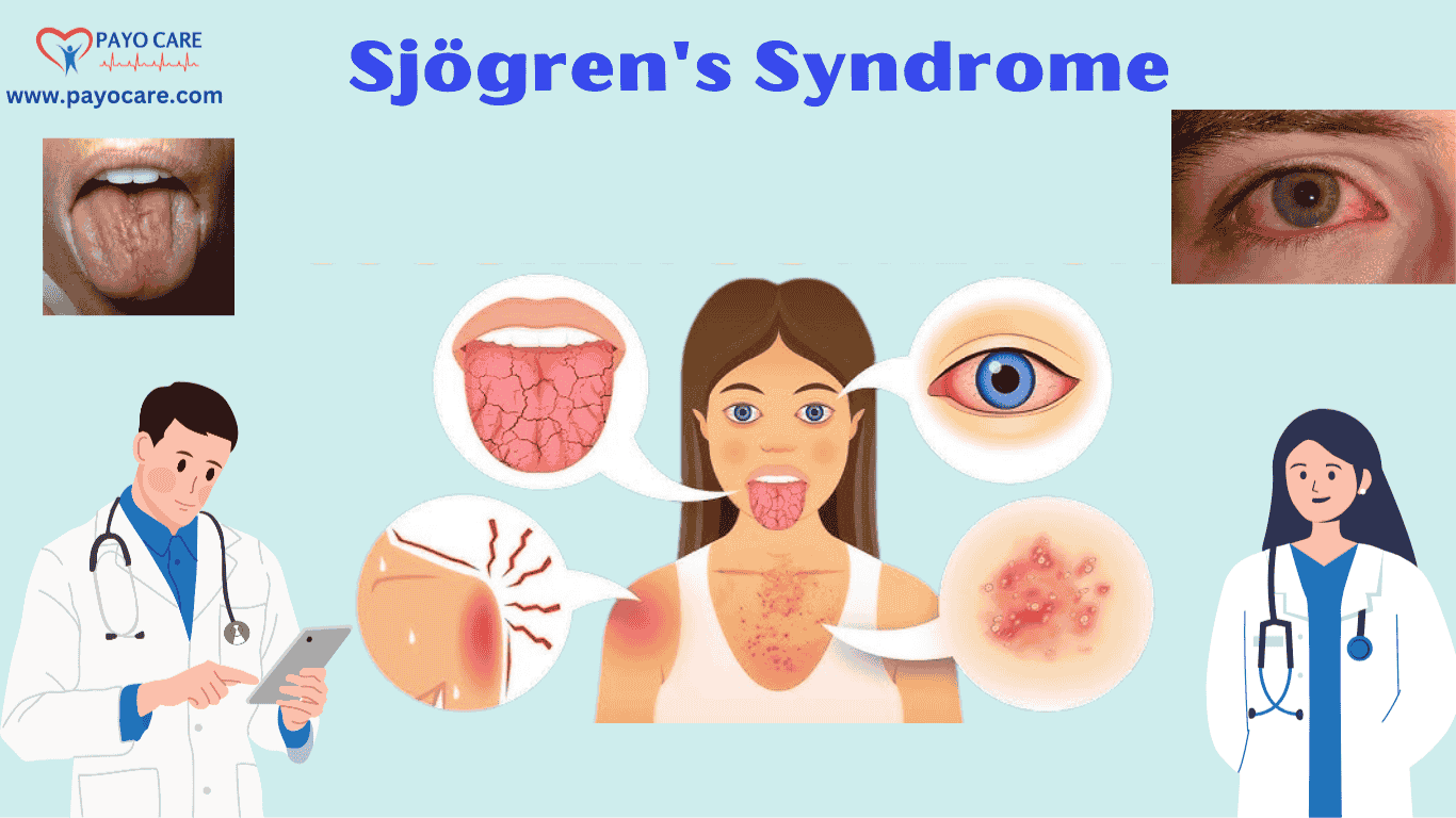 Sjögren’s Syndrome: Causes, Symptoms & Treatments