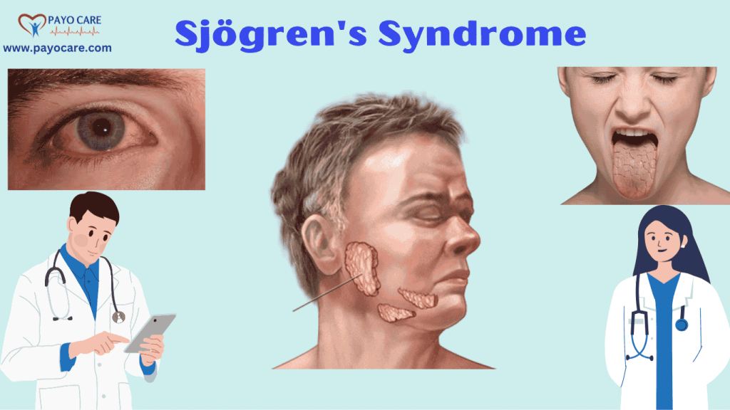 Sjögren's Syndrome: Causes, Symptoms & preventions Sjögren's Syndrome: Causes, Symptoms & preventions