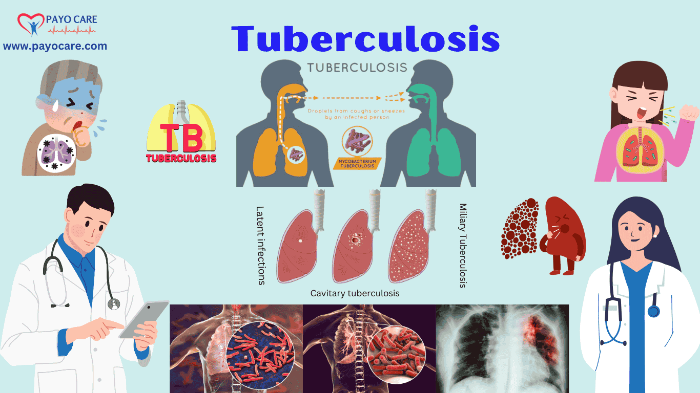 Tuberculosis: Causes, Symptoms, Prevention, & Treatment
