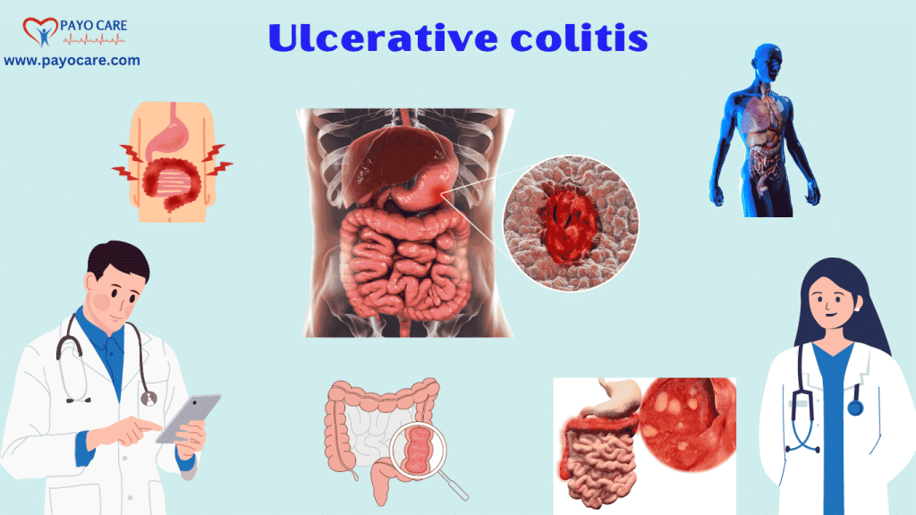 Ulcerative Colitis: Types, Causes, Symptoms, Prevention, Diagnosis & Treatment