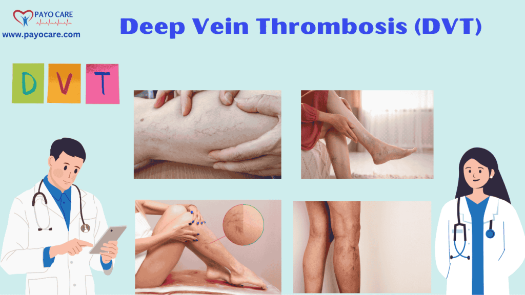 Deep Vein Thrombosis (DVT): Types, Causes, Symptoms, Prevention, and Treatments