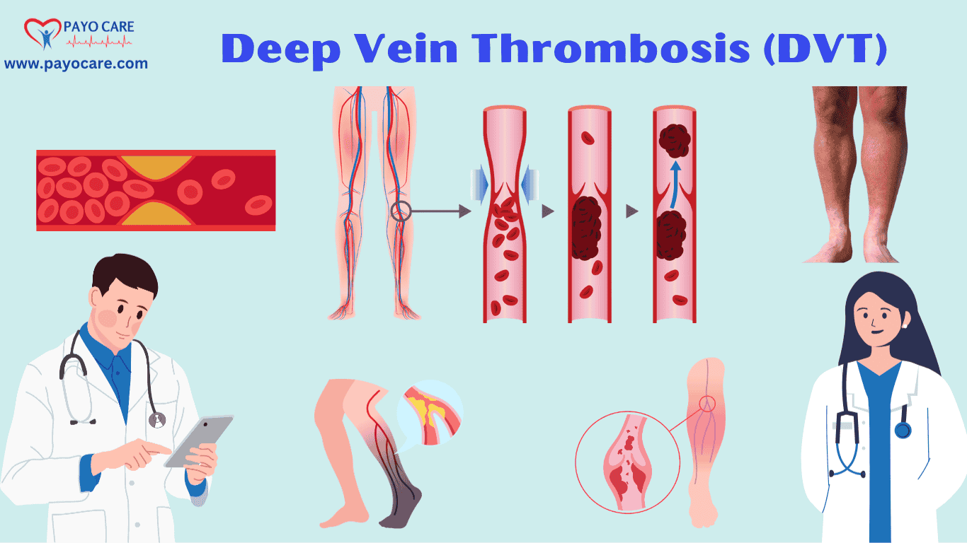 Deep Vein Thrombosis (DVT): Causes, Symptoms and Treatments