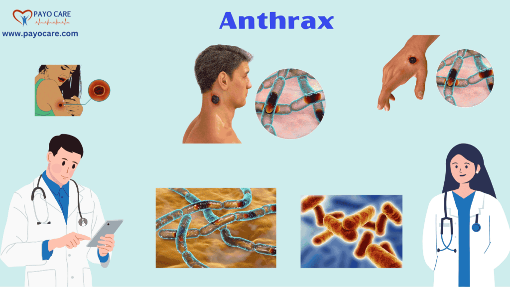 Anthrax :Causes, Symptoms and Treatment