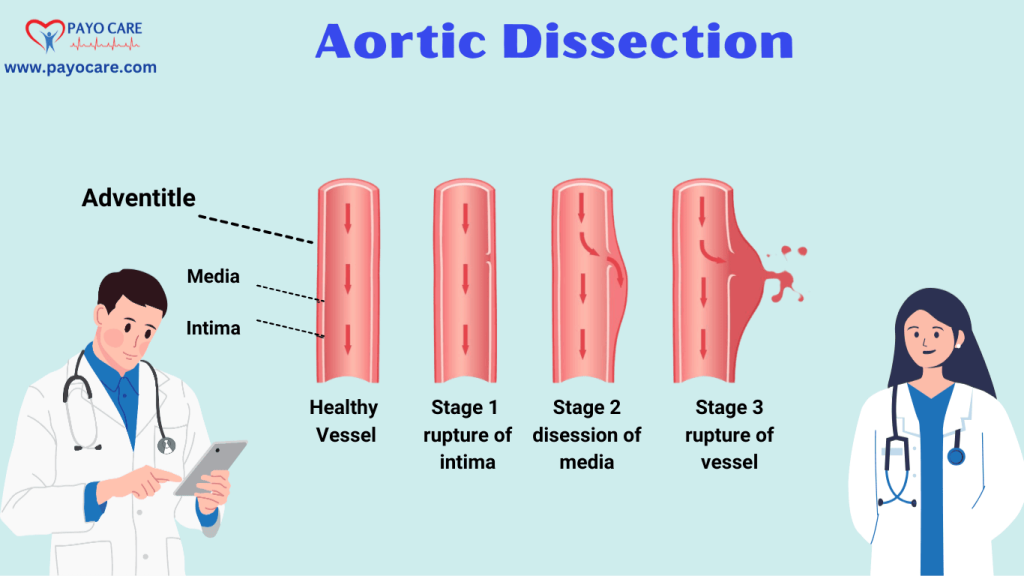 Aortic Dissection: Types, Causes and Treatment
