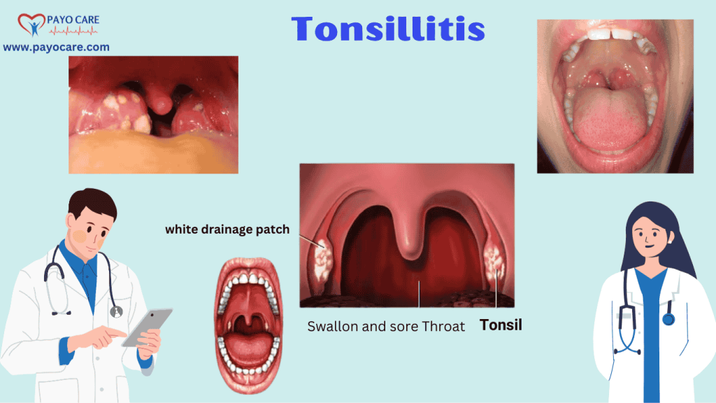 Tonsillitis: Types, Causes, Symptoms, Prevention, and Treatment Tonsillitis: Types, Causes, Symptoms, Prevention, and Treatment